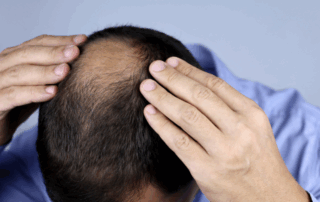 Hair Loss